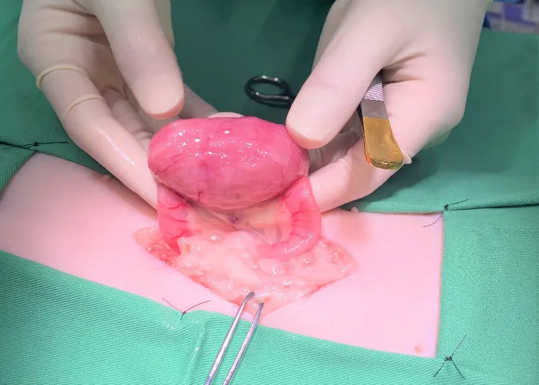 消化管腫瘍